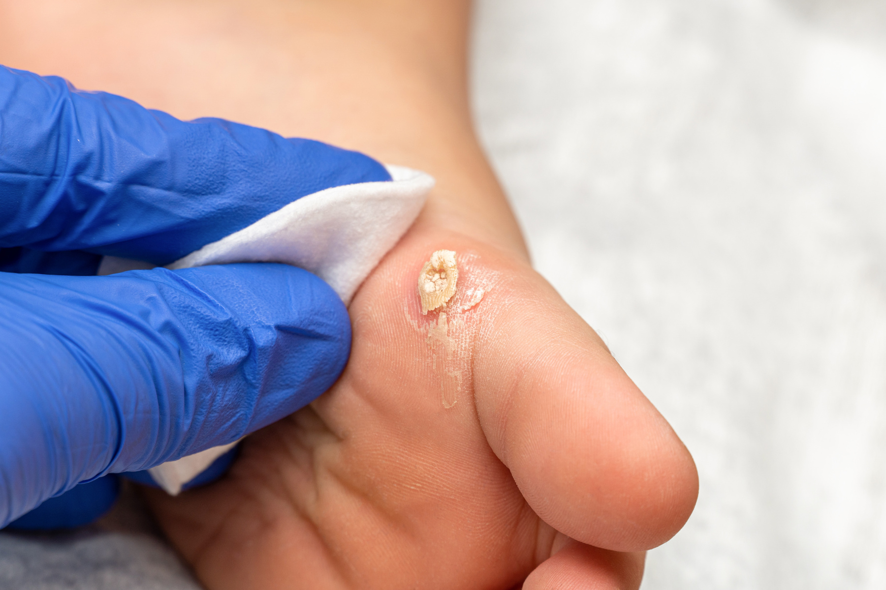 Healing treatment of cracked, dry wart, calluses on the child foot sole